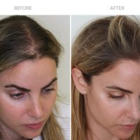 hairtransplant85